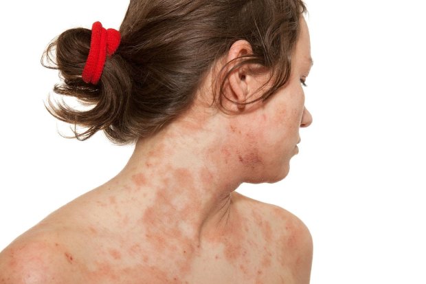 Пройдет ли аллергия после лечения лямблиоза